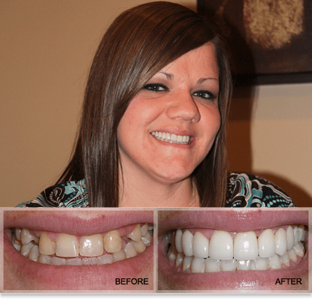 Missing Teeth Treated by Plano Dentist Dr. Grapevine Missing Teeth Treated by Plano Dentist Dr. Grapevine