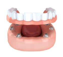implant secured denture plano tx implant dentist