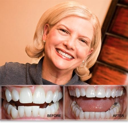 Smart Moves Treatment for Orthodontic Relapse by Plano TX Dentist Dr. Grapevine