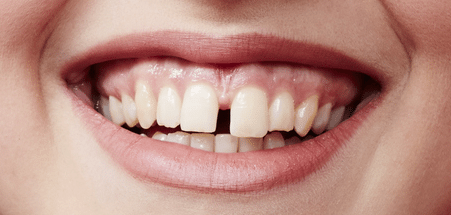 Fix tooth gaps plano tx cosmetic dentist