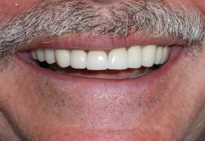 Dental Crown After Dental Crown After