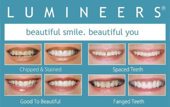 Plano Texas cosmetic dentist for lumineers