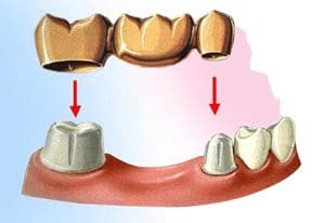 traditional dental bridge in Plano TX