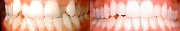 Invisalign Treatment by Plano, TX Dentist Dr. Grapveine