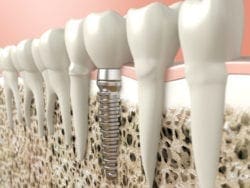 dental implant in jaw bone at Dr. Jacob Grapevine, DDS Signature Dentistry