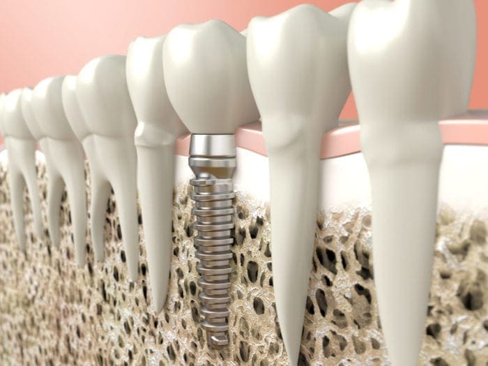 dental implant in jaw bone plano tx implant dentist