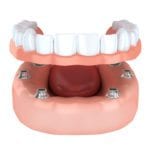 implant-secured denture in Plano TX 