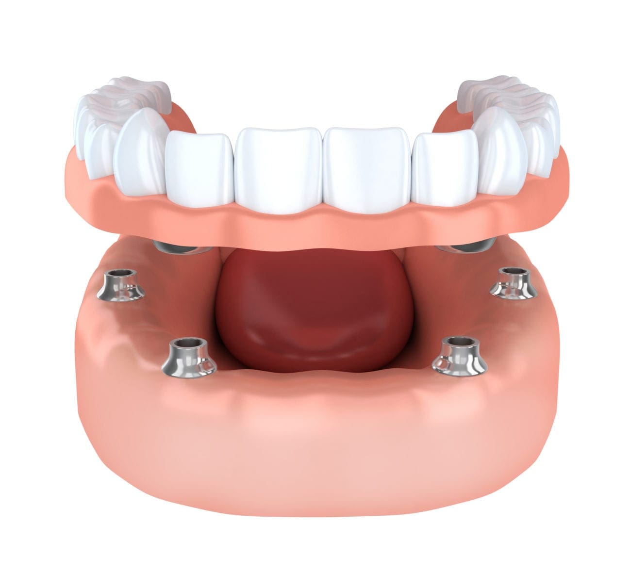 Implant secured denture specialist in Plano TX