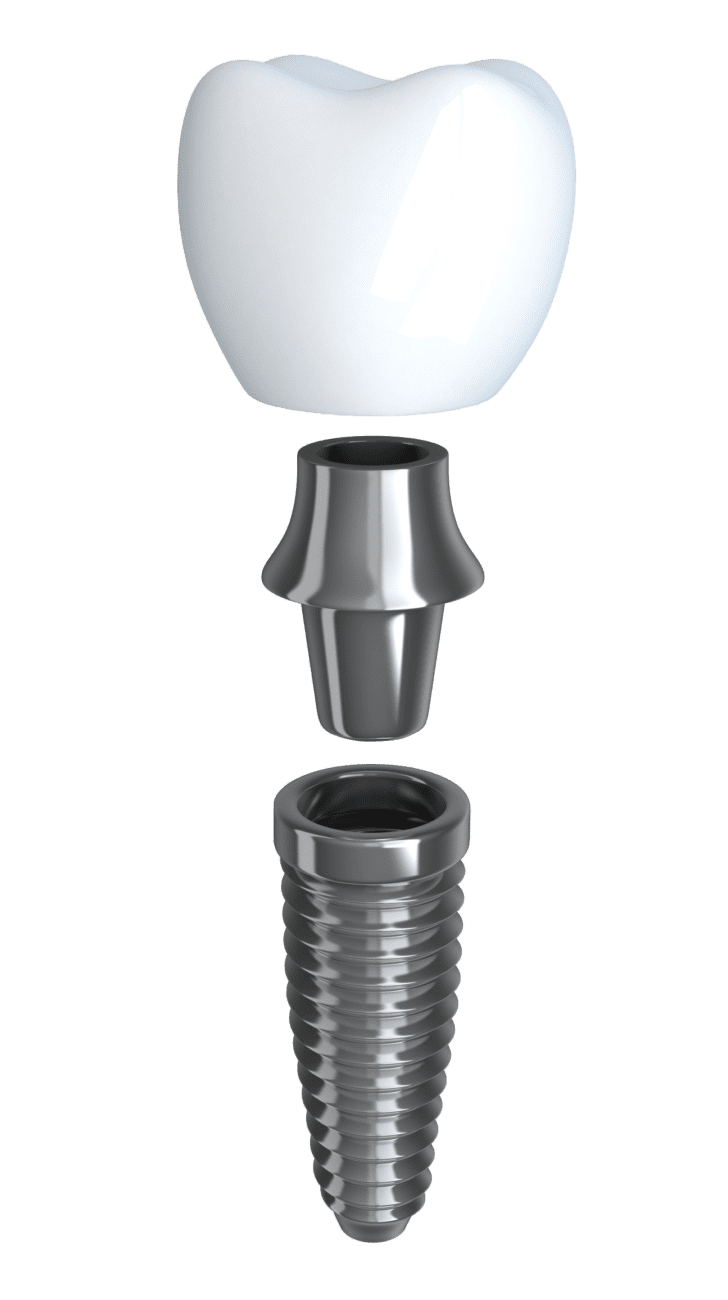Affordable dental implants near Frisco