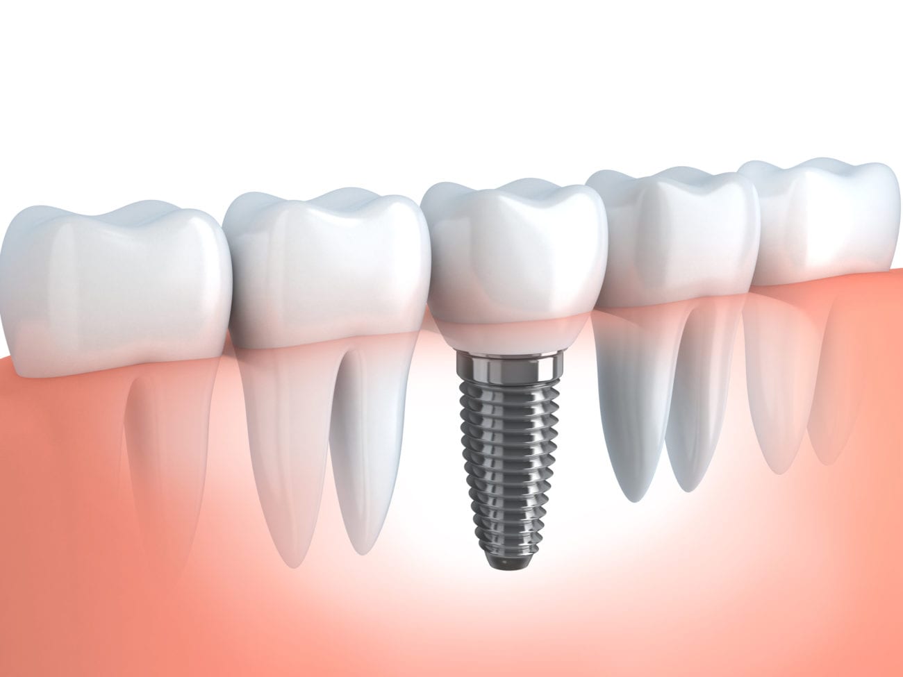 Dental Implants for missing teeth in Plano Texas