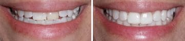 Porcelain veneers before and after at Dr. Jacob Grapevine's dental office in Plano, TX