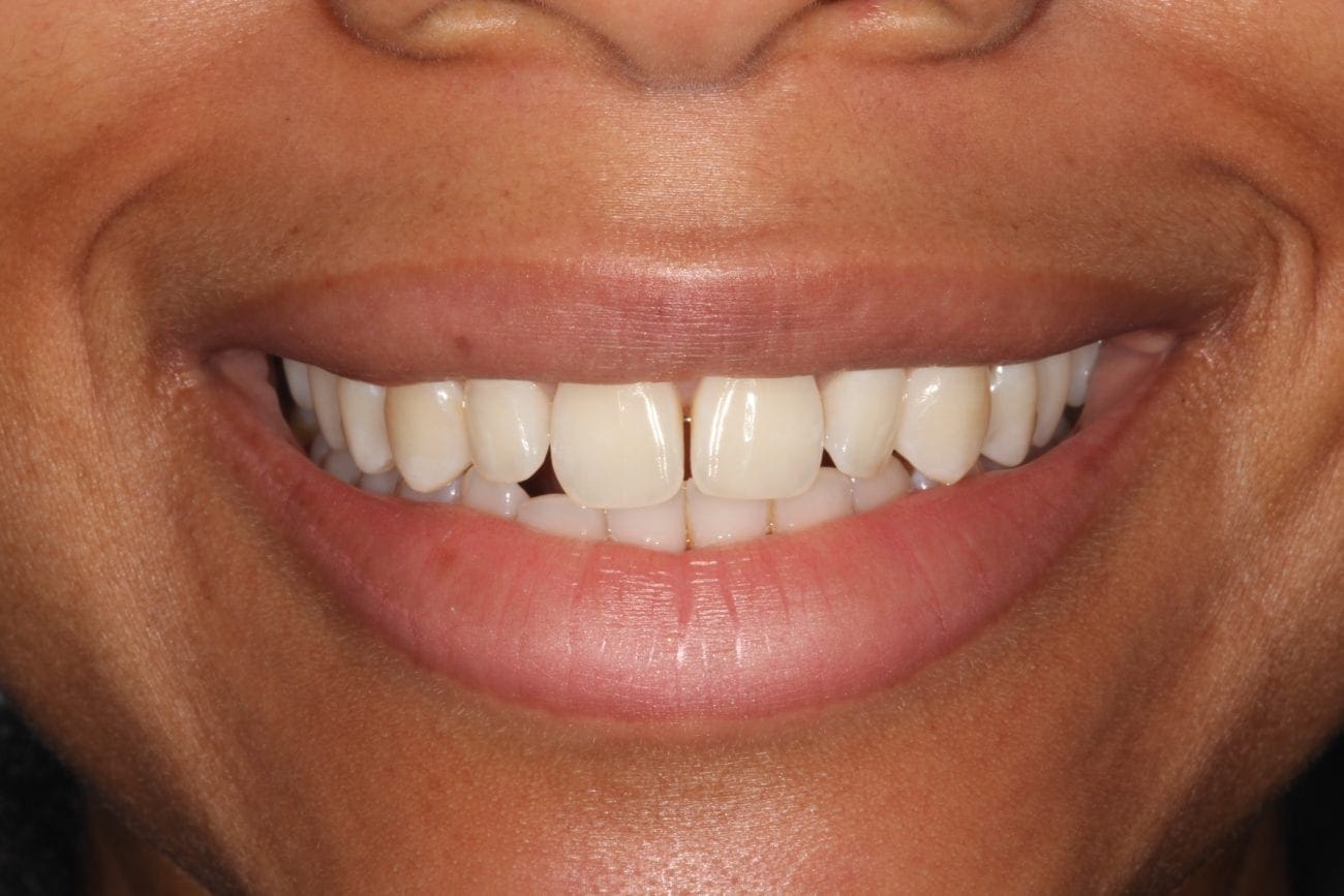 before cosmetic dentistry