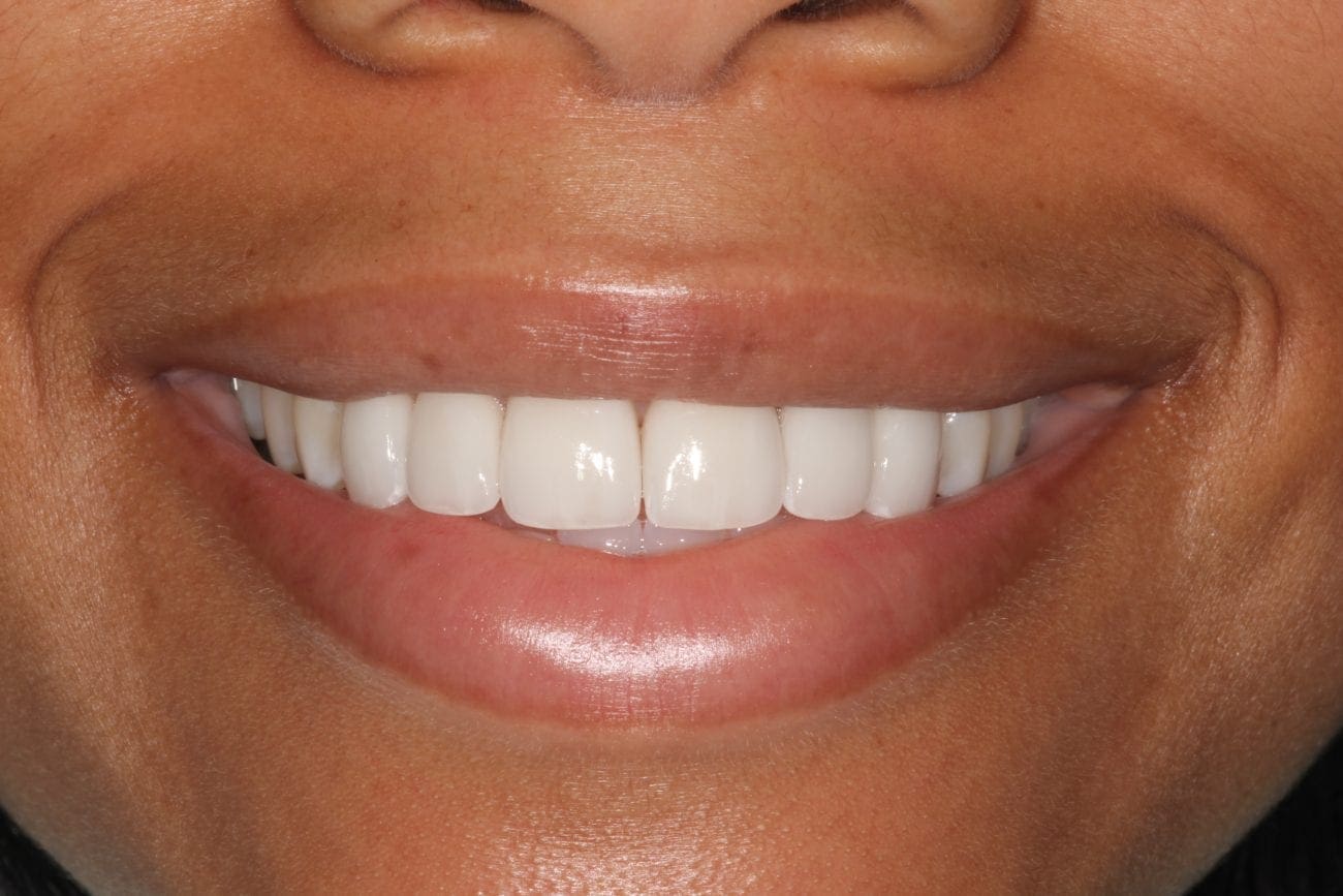 after cosmetic dentistry