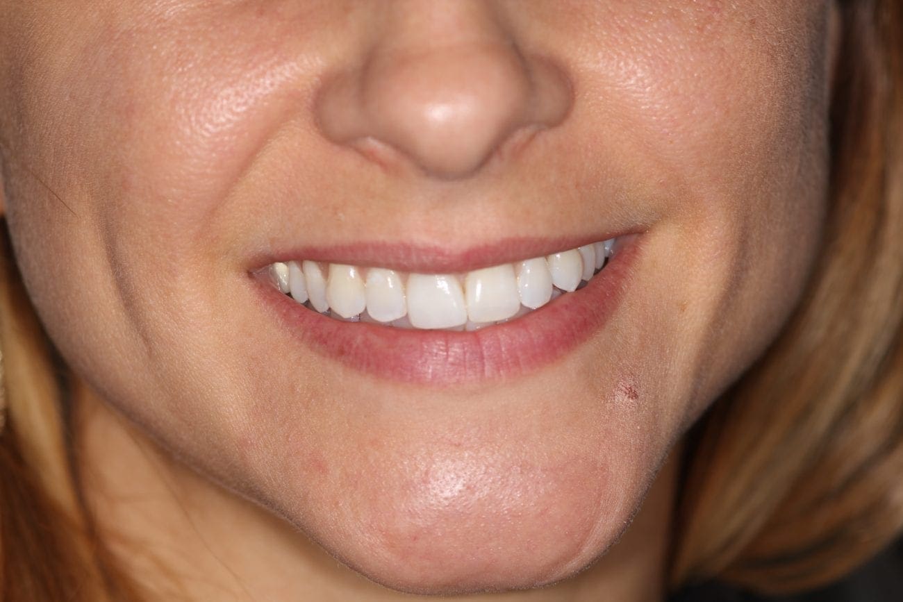 after cosmetic dentistry