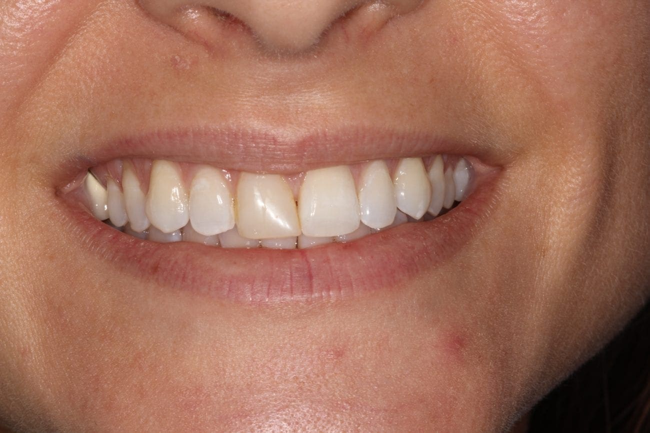 before cosmetic dentistry