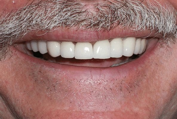 after cosmetic dentistry