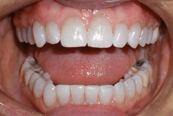 after cosmetic dentistry