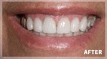 after cosmetic dentistry