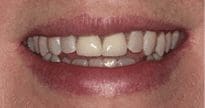 before cosmetic dentistry