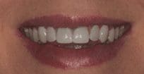 after cosmetic dentistry