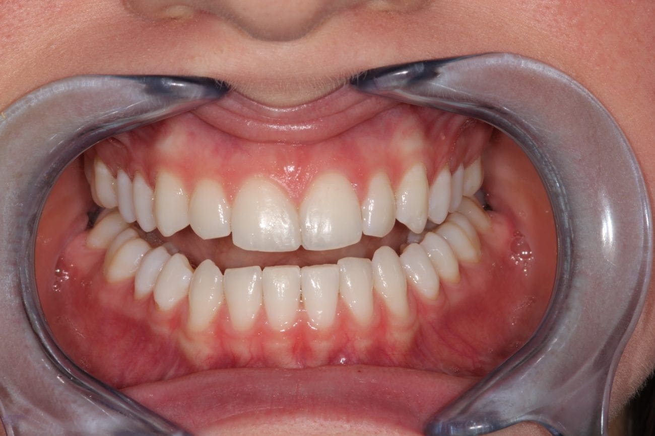 after cosmetic dentistry