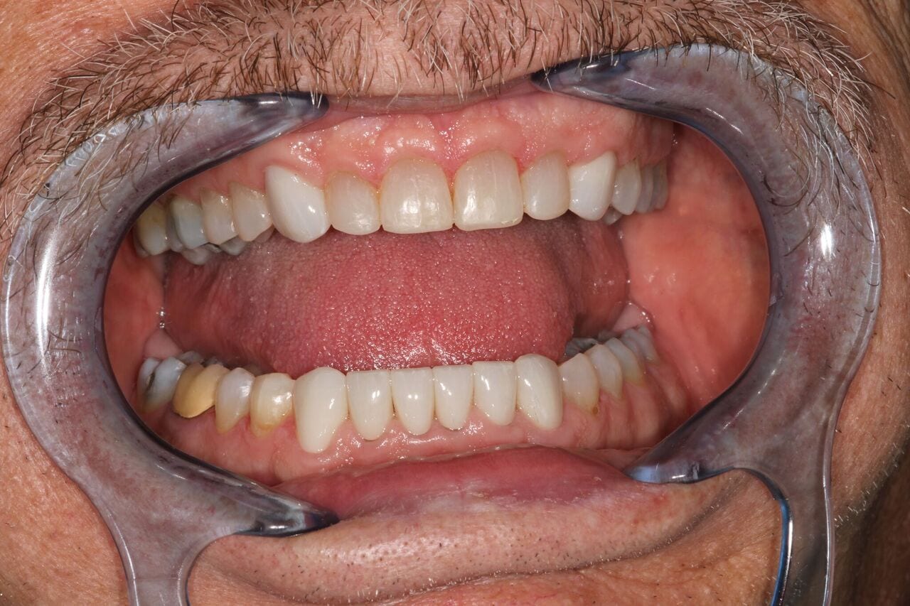 after cosmetic dentistry