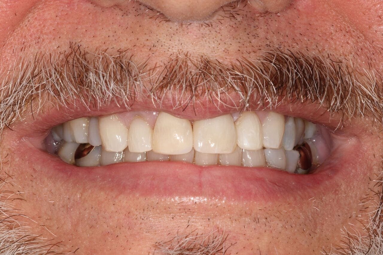 after cosmetic dentistry