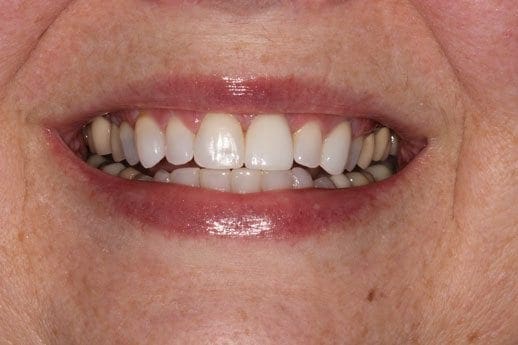 after cosmetic dentistry