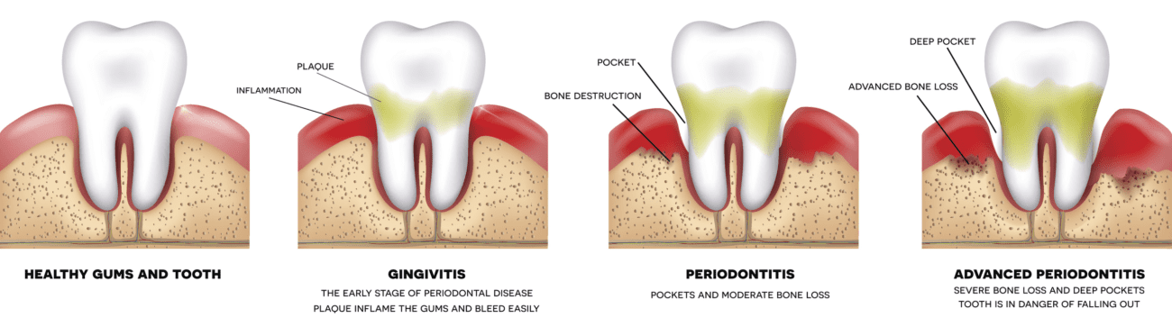 Periodontal therapy treatment in Plano Texas