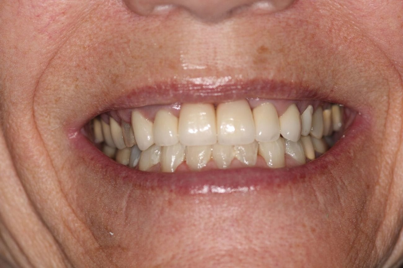 after cosmetic dentistry