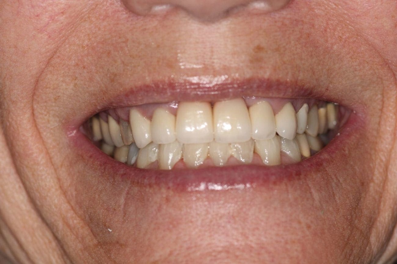 after cosmetic dentistry