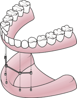 all on four dental implant-secured denture in Plano Texas