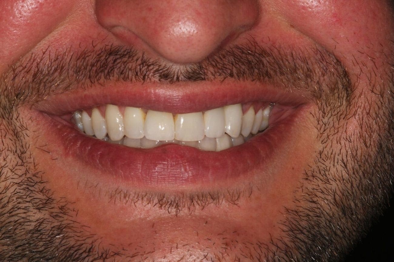 after cosmetic dentistry