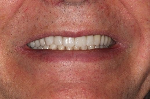 after cosmetic dentistry