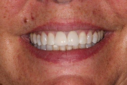 after cosmetic dentistry