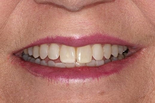 after cosmetic dentistry