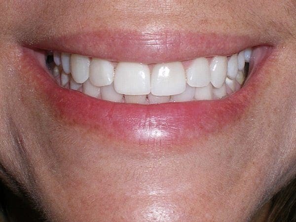 after cosmetic dentistry