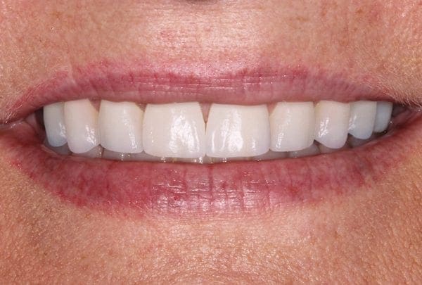 after cosmetic dentistry