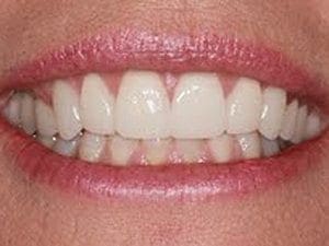 after cosmetic dentistry