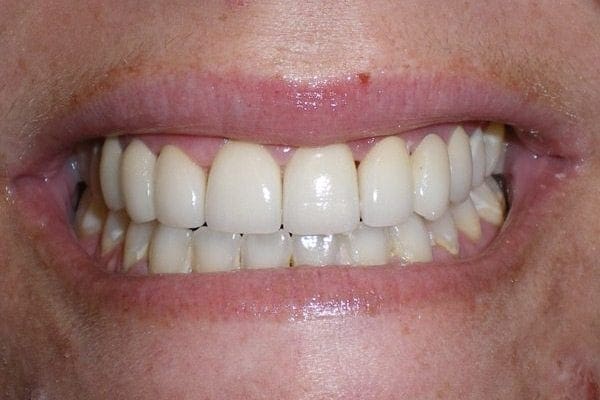 after cosmetic dentistry