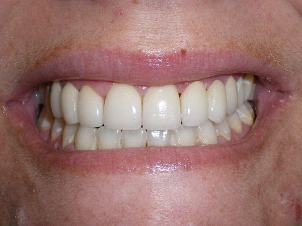 after cosmetic dentistry