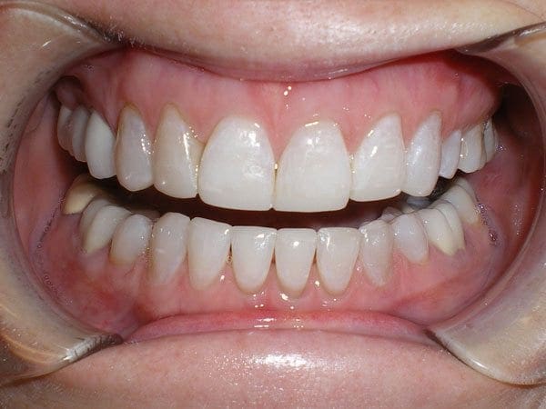 after cosmetic dentistry