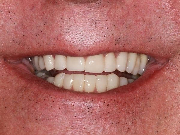 after cosmetic dentistry