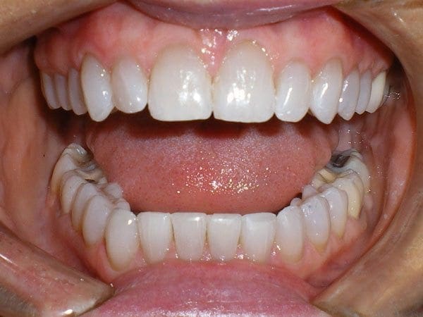 after cosmetic dentistry