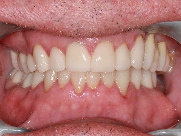 after cosmetic dentistry