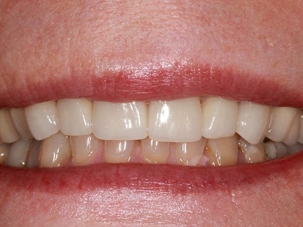 after cosmetic dentistry