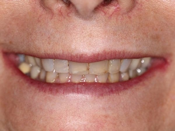 before cosmetic dentistry