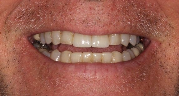 after cosmetic dentistry