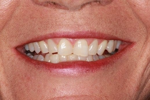 before cosmetic dentistry