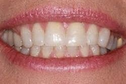 before cosmetic dentistry